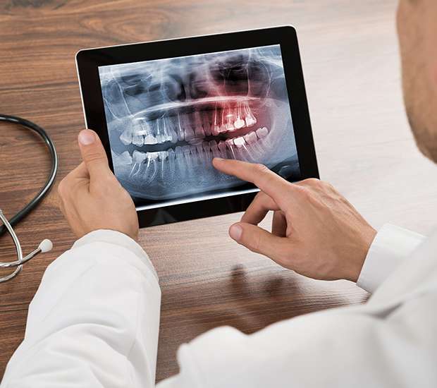 Boca Raton Types of Dental Root Fractures