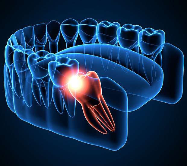 Boca Raton Wisdom Teeth Extraction
